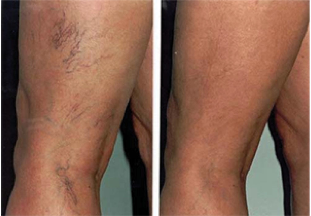 Sclerotherapy: Before and After (3)